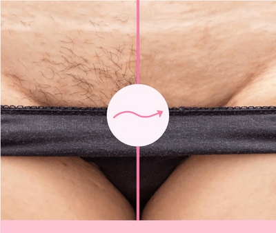 Sohoo Mermaid IPL-Laser Hair Removal