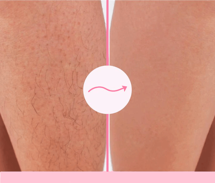 Sohoo Mermaid IPL-Laser Hair Removal