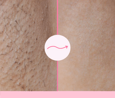 Sohoo Mermaid IPL-Laser Hair Removal